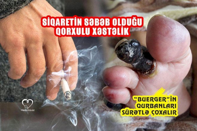    Siqaretin səbəb olduğu qorxulu xəstəlik    