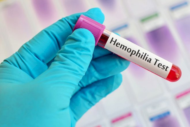    Dünyada hemofiliya xəstələrinin sayı 400 min nəfərdir   