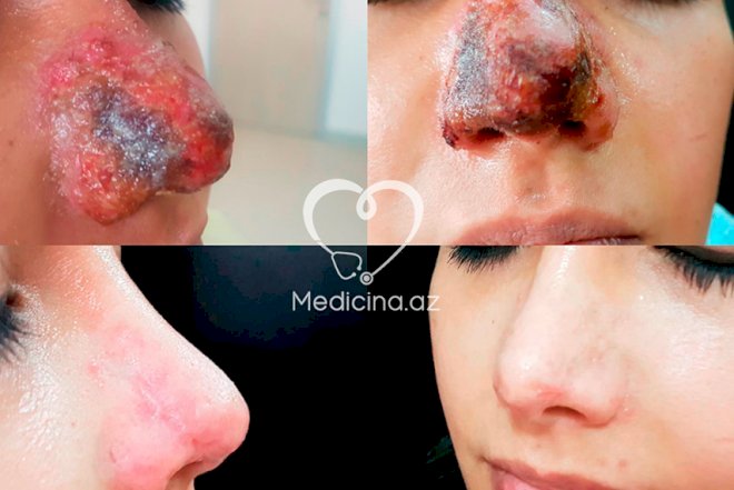    Azərbaycanda gənc qızın gel vurdurduğu burnu bu vəziyyətə düşdü   