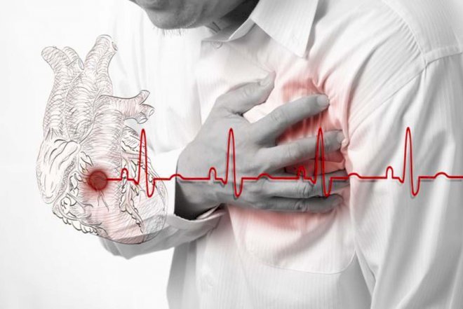    Hansı qan qrupu insanlar daha çox infarkt olur? -   Araşdırma