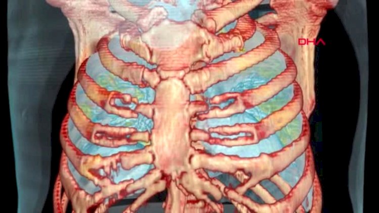    Koronavirusa yoluxanların ağciyərləri bu hala düşür -  Video   
