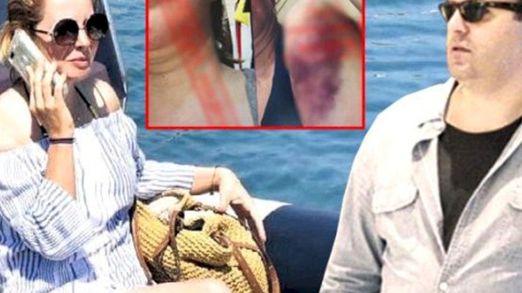    Keçmiş nazirin oğlu arvadını döyüb, qabırğalarını sındırdı - FOTO   