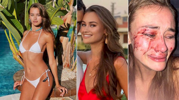    Məşhur modelin yalanı ortaya çıxdı: Sevgilisi tərəfindən döyülübmüş - Video   