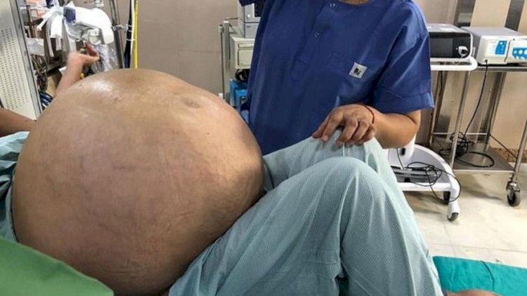    Qadının yumurtalığından 107 kiloqram şiş götürüldü   - Foto
