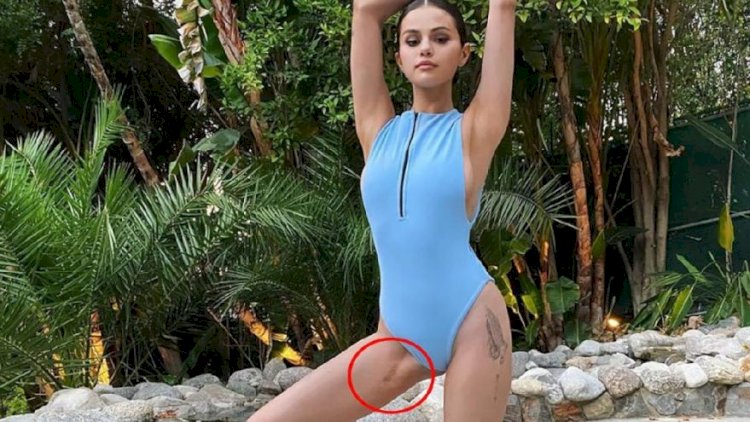    Selena Qomez yaralarını nümayiş etdirdi   - Foto