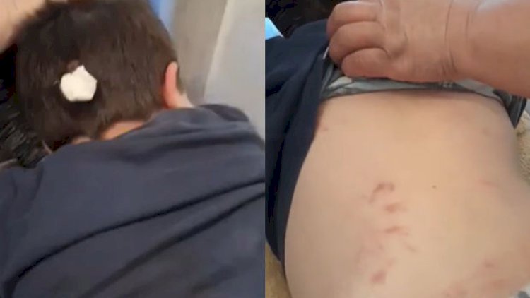    Gəncədə erməni terrorundan zərər çəkən azyaşlının görüntüləri ürək dağladı - Video   