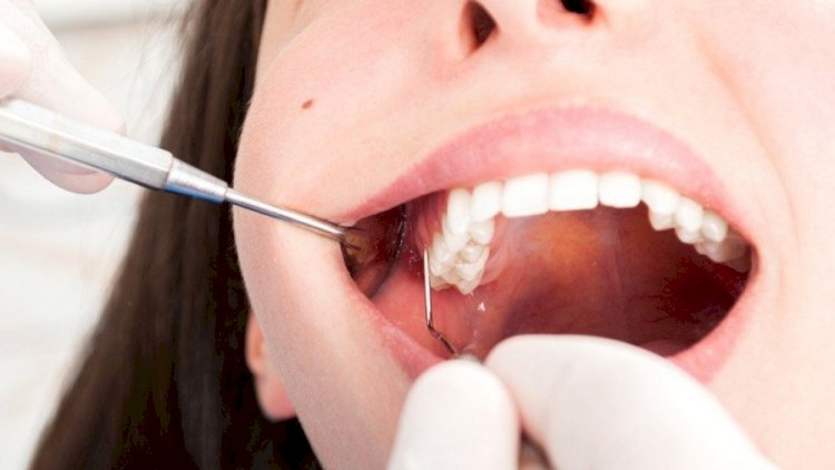    Koronavirus keçirənlərin dişləri niyə tökülür?   