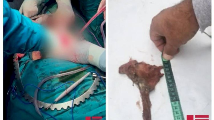    Yaşlı şəxsin qarnında 8 ay əvvəl unudulan tampon aşkar edildi   