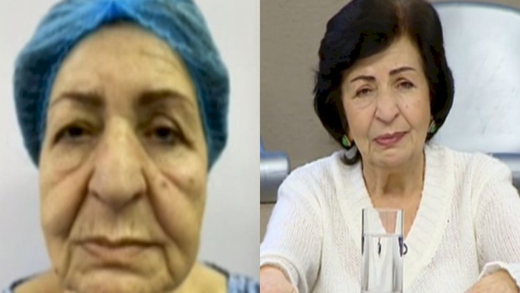    “Plastik əməliyyatla 15 yaş cavanlaşdım“ - Kübra Əliyeva   