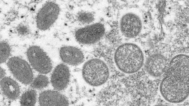    Koronavirus getdi, meymunçiçəyi gəldi? - Yoluxma sayı 3 dəfə artdı   