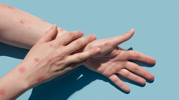    Azərbaycanda meymunçiçəyinə yoluxan var? - Nazirlikdən açıqlama   