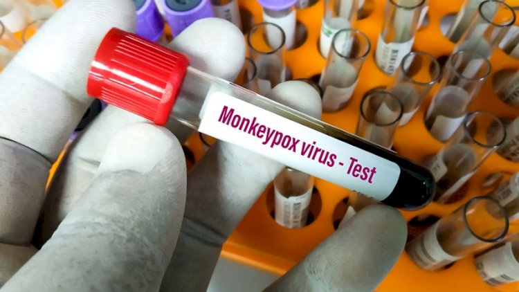    ÜST Azərbaycana meymunçiçəyi testlərini göndərdi   