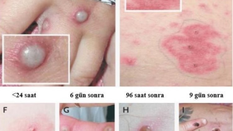   Hindistanda meymunçiçəyinə ilk yoluxma halı təsdiqləndi   