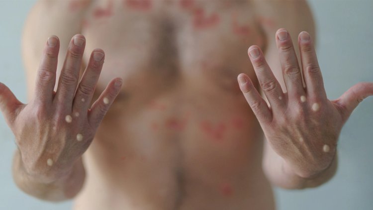    Meymunçiçəyinə yoluxanların çoxu homoseksual kişilərdir - Fransız nazir   