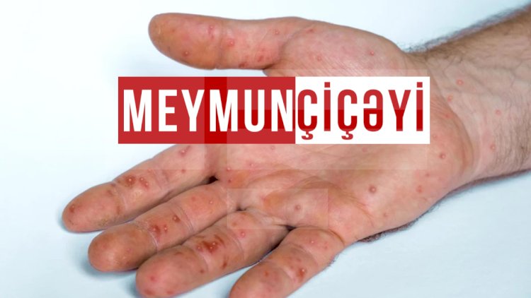    Azərbaycanda meymunçiçəyinə yoluxma qeydə alınıbmı?   