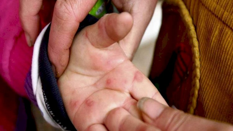    Bircə bu qalmışdı: Hindistanda “pomidor qripi” tapıldı    