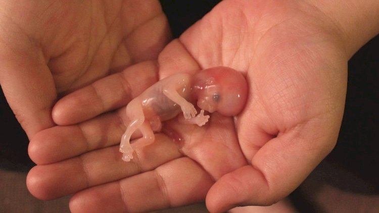    Azərbaycanda 15-17 yaşlı qızlar arasında abortlar artıb   