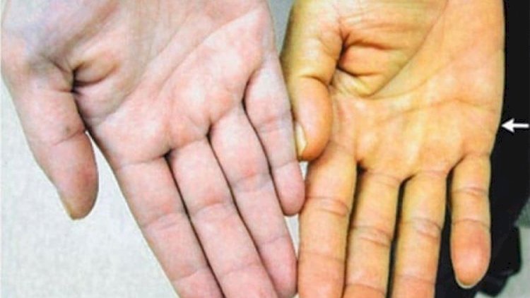    Dərinin rənginin dəyişməsi xərçəngdən ola bilər - DİQQƏT!    