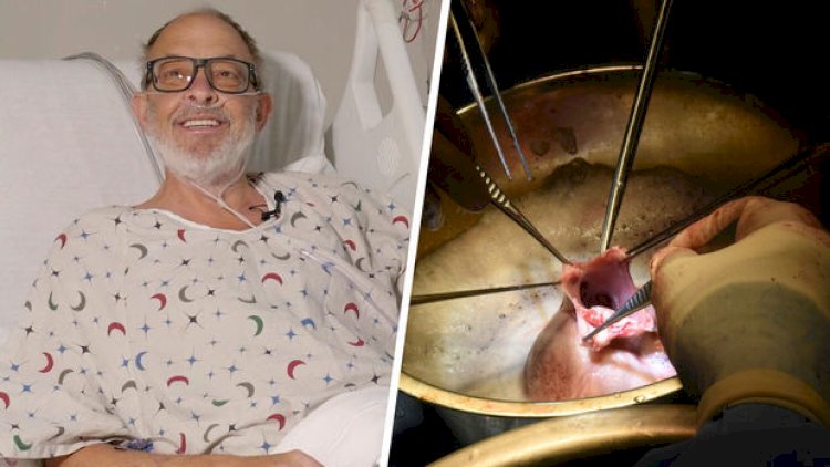    Donuz ürəyi transplantasiyası edilən ikinci xəstə dünyasını dəyişdi   