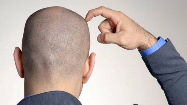    Saç tökülməsi problemi olanların nəzərinə! Bunu sınayanlar keçəllikdən   XİLAS OLUR