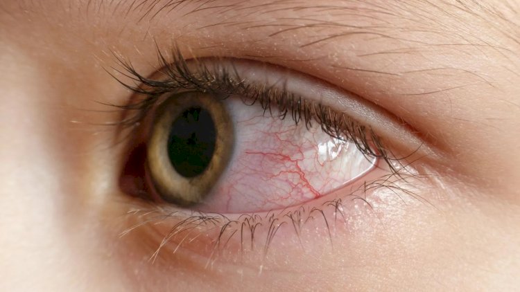   Qızartı, qabıqlanma, şişkinlik: İnsanları kor edən yeni virus   