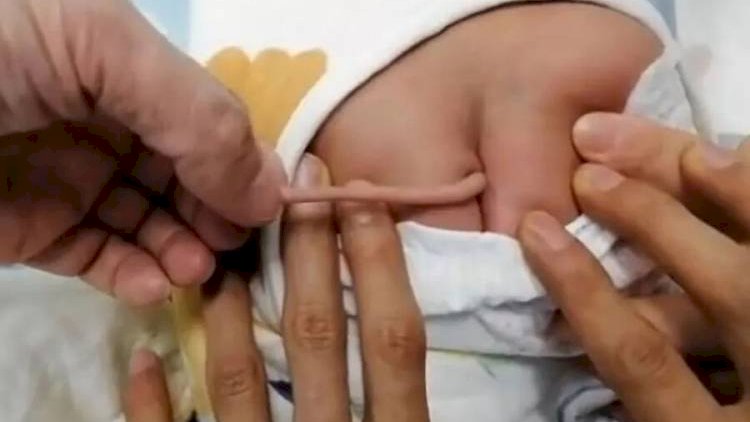   Dünyanı şoka salan hadisə: Quyruqlu uşaq doğuldu   