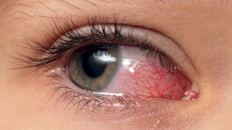    Dəhşətli virus yayıldı- Yoluxanların sayı sürətlə artır    