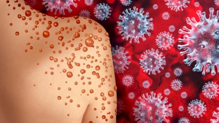    Səhiyyə naziri ölkədə epidemiya elanı verdi   