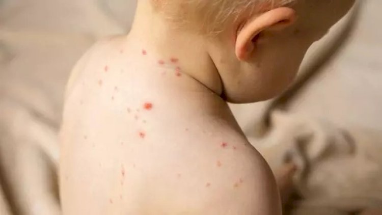    Bu epidemiya sürətlə yayılır   