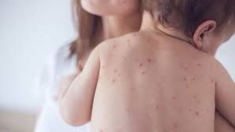    Qızılca yenə can aldı - Virus Azərbaycandan nə vaxt “çıxacaq”?    