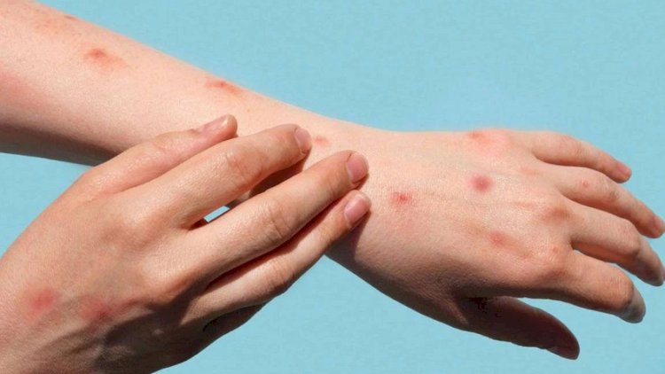    Azərbaycanda meymunçiçəyi virusu ilə bağlı daha bir qurum hərəkətə keçdi   