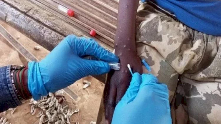    ŞOK RƏQƏM: Meymunçiçəyinə yoluxanların sayı 23 minə çatdı   