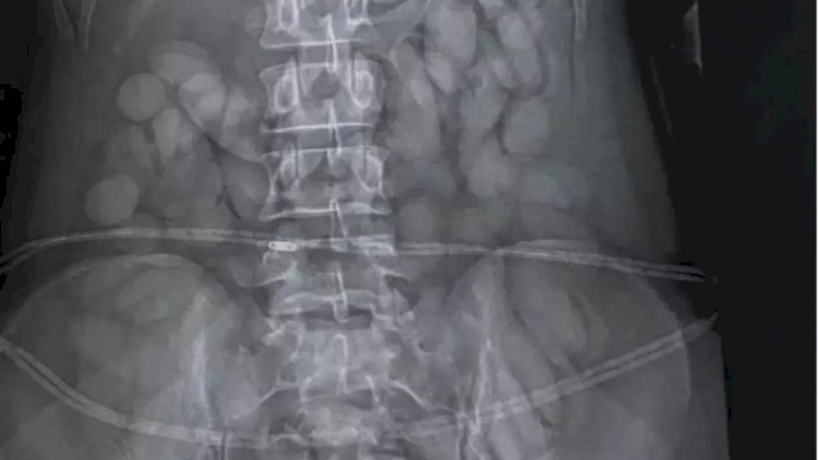    Mədəsində çoxlu narkotik kapsul olan qadın həbs edildi – Foto   