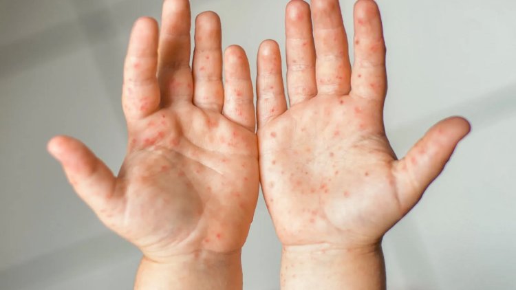    Yaponiyada bu infeksiyaya yoluxanların sayı artır   