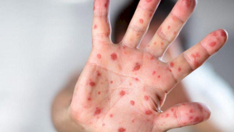    Qızılca və suçiçəyi ilə bağlı epidemioloji vəziyyət necədir?   