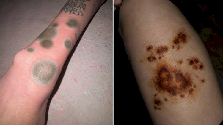    İlk baxışda xəstəlik kimi görünür: Rusiyada yeni döymə trendi ŞOK yaratdı   